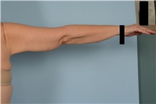 Arm Lift After Photo by Ellen Janetzke, MD; Bloomfield Hills, MI - Case 48352