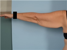 Arm Lift Before Photo by Ellen Janetzke, MD; Bloomfield Hills, MI - Case 48352