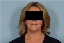 Liposuction Before Photo by Ellen Janetzke, MD; Bloomfield Hills, MI - Case 48353