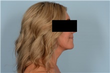 Liposuction After Photo by Ellen Janetzke, MD; Bloomfield Hills, MI - Case 48353