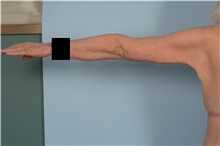 Arm Lift After Photo by Ellen Janetzke, MD; Bloomfield Hills, MI - Case 48388