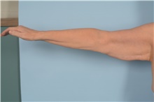 Arm Lift Before Photo by Ellen Janetzke, MD; Bloomfield Hills, MI - Case 48388
