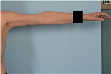 Arm Lift After Photo by Ellen Janetzke, MD; Bloomfield Hills, MI - Case 48388