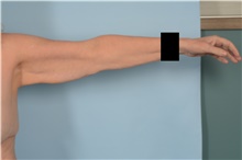 Arm Lift Before Photo by Ellen Janetzke, MD; Bloomfield Hills, MI - Case 48388