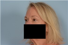 Eyelid Surgery After Photo by Ellen Janetzke, MD; Bloomfield Hills, MI - Case 48389
