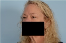 Eyelid Surgery Before Photo by Ellen Janetzke, MD; Bloomfield Hills, MI - Case 48389
