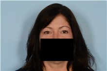 Eyelid Surgery Before Photo by Ellen Janetzke, MD; Bloomfield Hills, MI - Case 48391