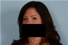 Eyelid Surgery After Photo by Ellen Janetzke, MD; Bloomfield Hills, MI - Case 48391