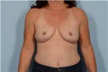 Breast Lift After Photo by Ellen Janetzke, MD; Bloomfield Hills, MI - Case 48392
