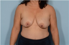 Breast Lift Before Photo by Ellen Janetzke, MD; Bloomfield Hills, MI - Case 48392