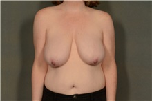 Breast Reduction Before Photo by Ellen Janetzke, MD; Bloomfield Hills, MI - Case 48484