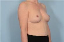 Breast Reduction After Photo by Ellen Janetzke, MD; Bloomfield Hills, MI - Case 48484
