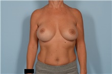 Breast Augmentation After Photo by Ellen Janetzke, MD; Bloomfield Hills, MI - Case 48485