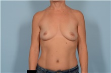 Breast Augmentation Before Photo by Ellen Janetzke, MD; Bloomfield Hills, MI - Case 48485