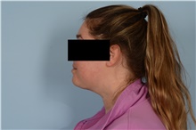 Liposuction After Photo by Ellen Janetzke, MD; Bloomfield Hills, MI - Case 48486