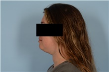 Liposuction Before Photo by Ellen Janetzke, MD; Bloomfield Hills, MI - Case 48486