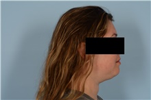Liposuction Before Photo by Ellen Janetzke, MD; Bloomfield Hills, MI - Case 48486