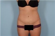 Tummy Tuck After Photo by Ellen Janetzke, MD; Bloomfield Hills, MI - Case 48487