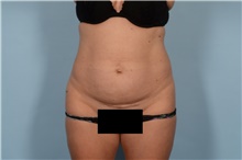 Tummy Tuck Before Photo by Ellen Janetzke, MD; Bloomfield Hills, MI - Case 48487