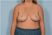 Breast Reduction After Photo by Ellen Janetzke, MD; Bloomfield Hills, MI - Case 48502