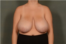 Breast Reduction Before Photo by Ellen Janetzke, MD; Bloomfield Hills, MI - Case 48502