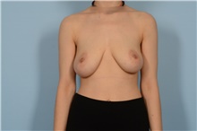 Breast Reduction Before Photo by Ellen Janetzke, MD; Bloomfield Hills, MI - Case 48650