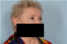 Eyelid Surgery After Photo by Ellen Janetzke, MD; Bloomfield Hills, MI - Case 48679
