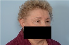 Eyelid Surgery Before Photo by Ellen Janetzke, MD; Bloomfield Hills, MI - Case 48679