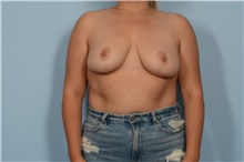 Breast Reduction After Photo by Ellen Janetzke, MD; Bloomfield Hills, MI - Case 49001