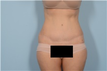 Tummy Tuck After Photo by Ellen Janetzke, MD; Bloomfield Hills, MI - Case 49002