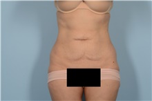 Tummy Tuck Before Photo by Ellen Janetzke, MD; Bloomfield Hills, MI - Case 49002