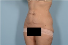 Tummy Tuck Before Photo by Ellen Janetzke, MD; Bloomfield Hills, MI - Case 49002