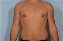 Male Breast Reduction After Photo by Ellen Janetzke, MD; Bloomfield Hills, MI - Case 49052