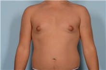 Male Breast Reduction Before Photo by Ellen Janetzke, MD; Bloomfield Hills, MI - Case 49052