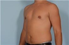 Male Breast Reduction After Photo by Ellen Janetzke, MD; Bloomfield Hills, MI - Case 49052