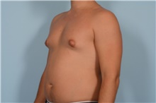 Male Breast Reduction Before Photo by Ellen Janetzke, MD; Bloomfield Hills, MI - Case 49052