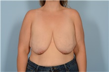 Breast Lift Before Photo by Ellen Janetzke, MD; Bloomfield Hills, MI - Case 49248