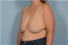 Breast Lift Before Photo by Ellen Janetzke, MD; Bloomfield Hills, MI - Case 49248