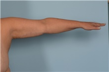 Arm Lift After Photo by Ellen Janetzke, MD; Bloomfield Hills, MI - Case 49249