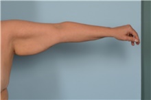 Arm Lift Before Photo by Ellen Janetzke, MD; Bloomfield Hills, MI - Case 49249