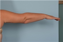 Arm Lift After Photo by Ellen Janetzke, MD; Bloomfield Hills, MI - Case 49250