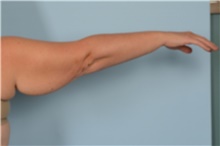 Arm Lift Before Photo by Ellen Janetzke, MD; Bloomfield Hills, MI - Case 49250