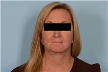 Facelift After Photo by Ellen Janetzke, MD; Bloomfield Hills, MI - Case 49251