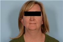 Facelift Before Photo by Ellen Janetzke, MD; Bloomfield Hills, MI - Case 49251