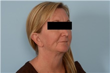 Facelift After Photo by Ellen Janetzke, MD; Bloomfield Hills, MI - Case 49251