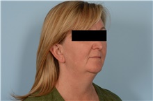 Facelift Before Photo by Ellen Janetzke, MD; Bloomfield Hills, MI - Case 49251