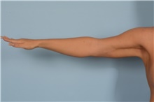 Arm Lift After Photo by Ellen Janetzke, MD; Bloomfield Hills, MI - Case 49276