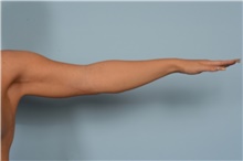 Arm Lift After Photo by Ellen Janetzke, MD; Bloomfield Hills, MI - Case 49276