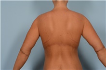 Body Lift After Photo by Ellen Janetzke, MD; Bloomfield Hills, MI - Case 49277