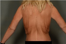 Body Lift Before Photo by Ellen Janetzke, MD; Bloomfield Hills, MI - Case 49277